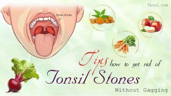 tonsil stones