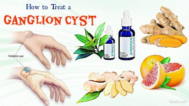 how to treat a ganglion cyst naturally