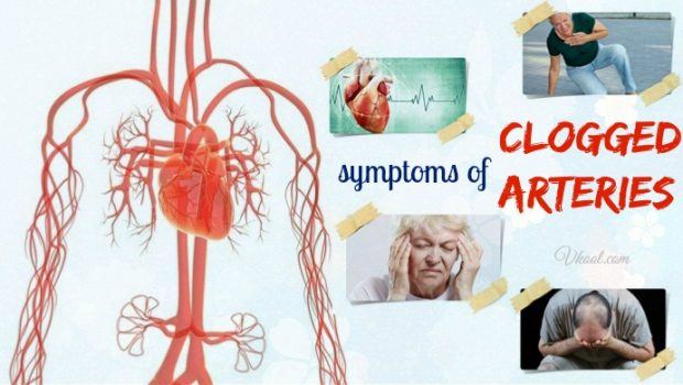 signs and symptoms of clogged arteries