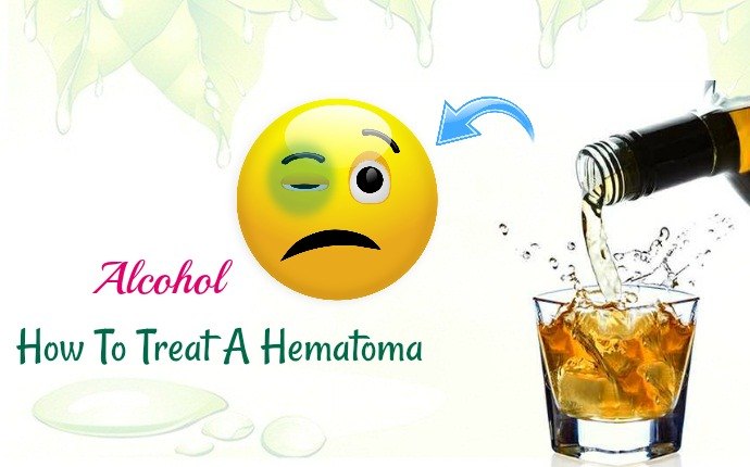 how to treat a hematoma - alcohol