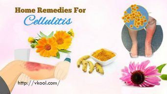home remedies for cellulitis on legs