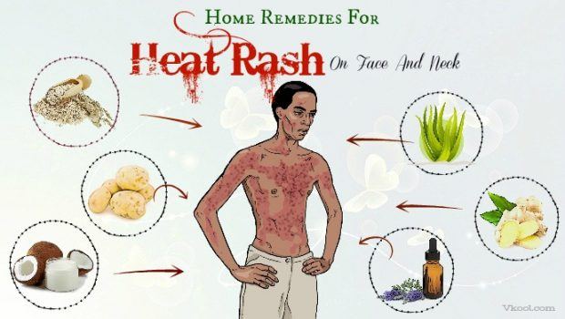 home remedies for heat rash on face
