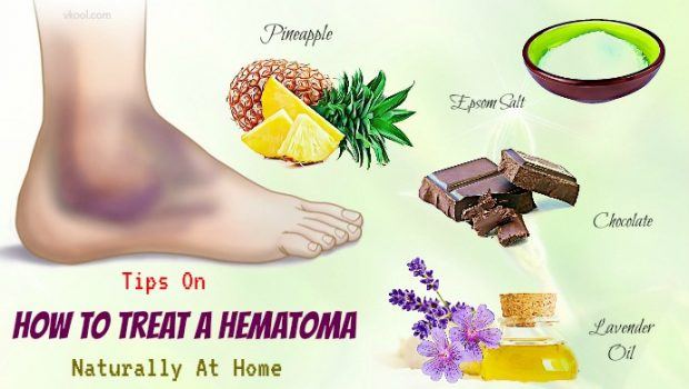 how to treat a hematoma at home