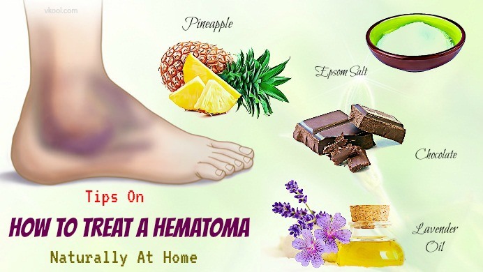 how to treat a hematoma at home