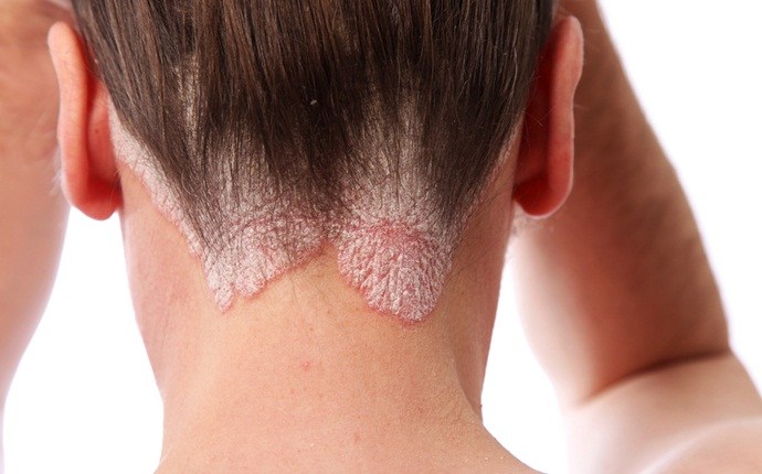 causes of itchy scalp - psoriasis