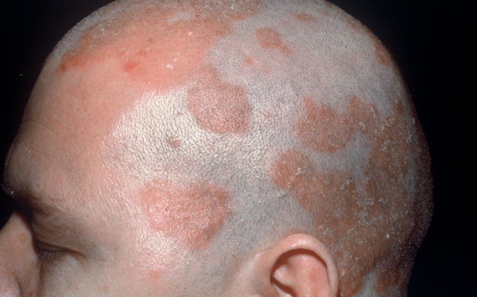 causes of itchy scalp - tinea capitis