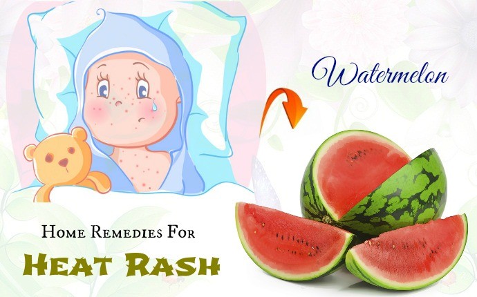 home remedies for heat rash - watermelon