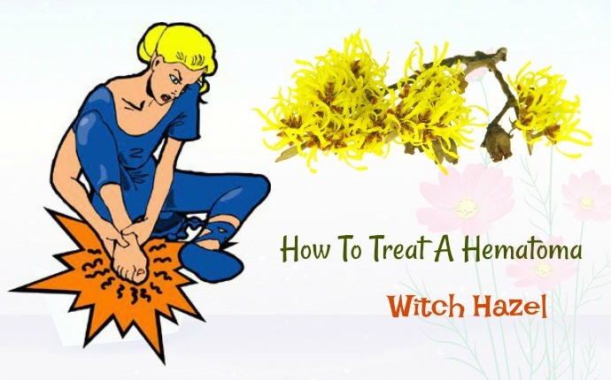 how to treat a hematoma - witch hazel
