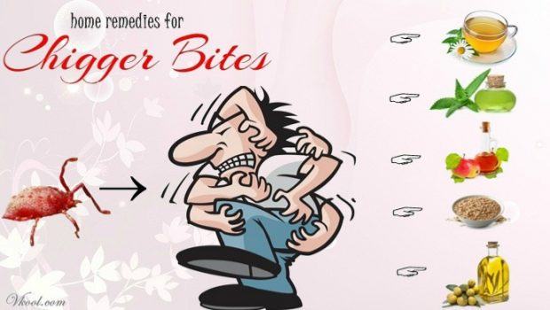natural home remedies for chigger bites