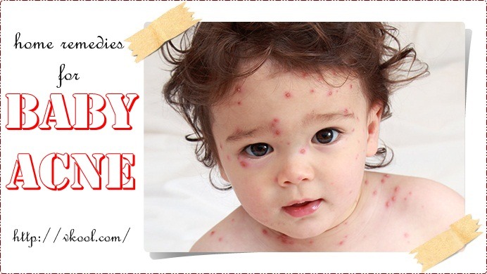 natural home remedies for baby acne