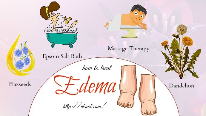 how to treat edema in legs