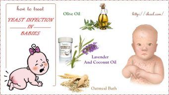 how to treat yeast infection in babies naturally