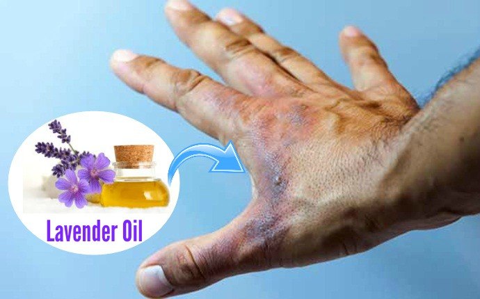 first aid for burns - lavender oil