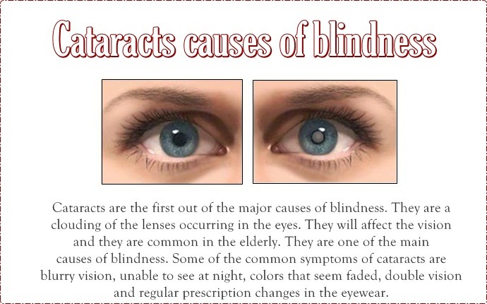 causes of blindness - cataracts