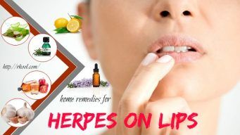 herpes on lips