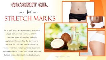 coconut oil for stretch marks removal
