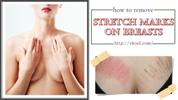 how to remove stretch marks on breasts naturally