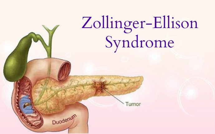 causes of peptic ulcer - zollinger-ellison syndrome