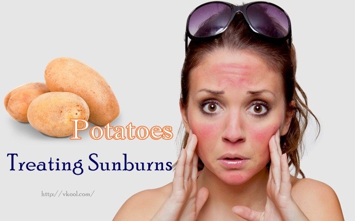 uses for potatoes - treating sunburns