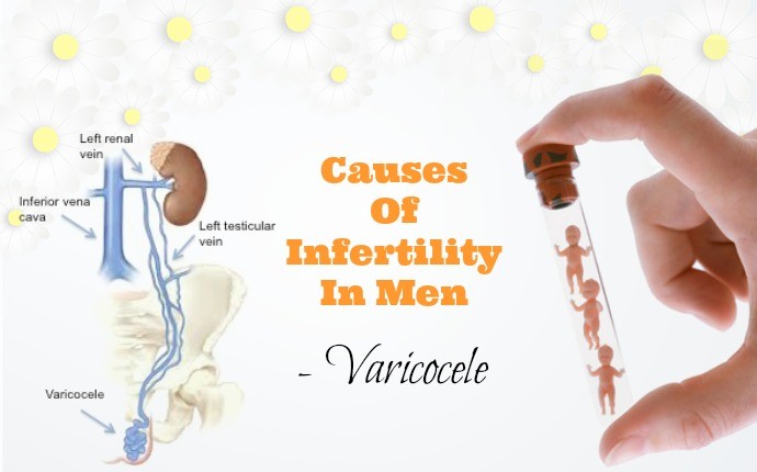 causes of infertility - varicocele
