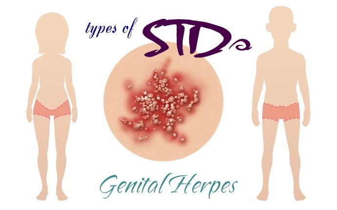 types of stds - genital herpes