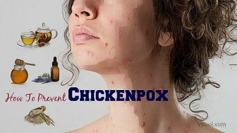 how to prevent chickenpox naturally