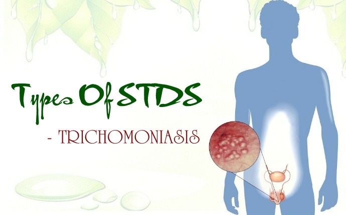 types of stds - trichomoniasis