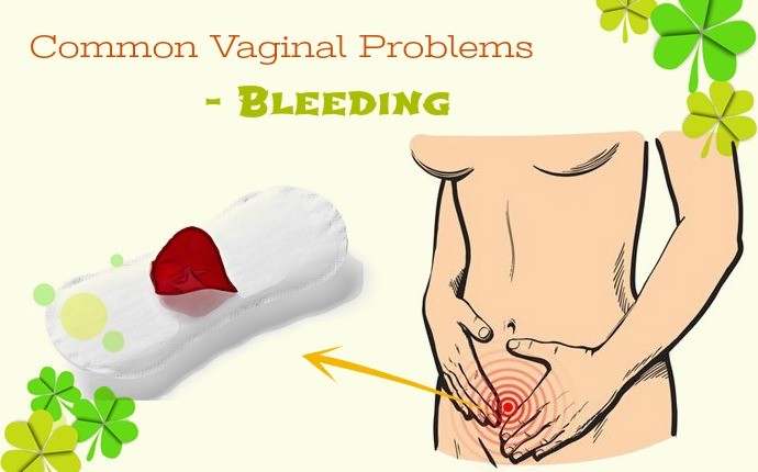 common vaginal problems - bleeding